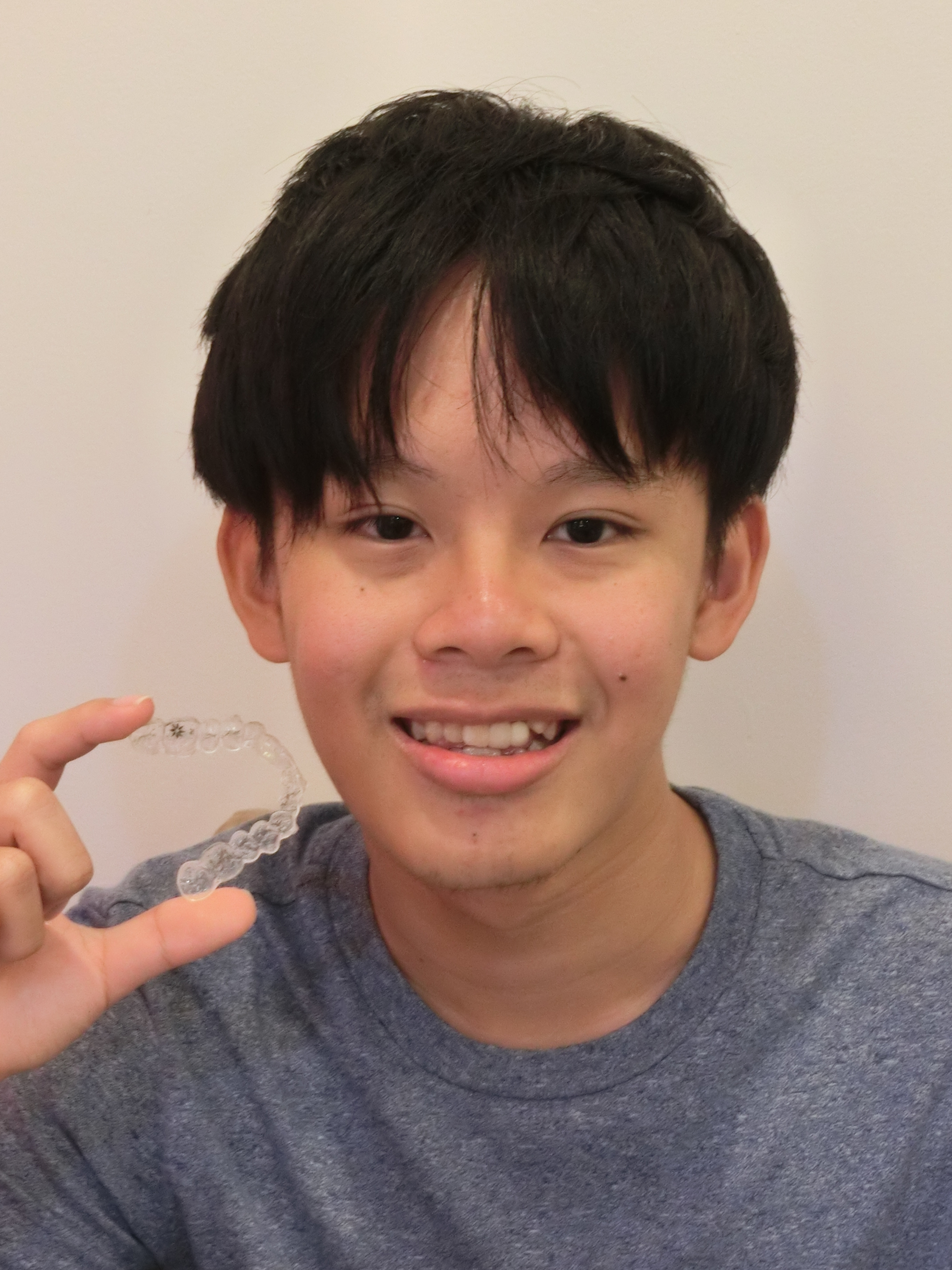 Invisalign Diary #JE Neo