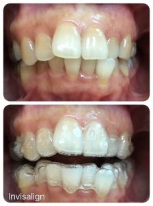 invisalign-mh-tan-02