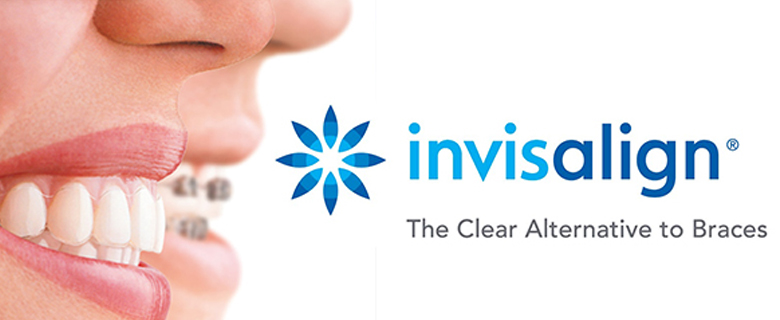 Invisalign Diary #MH TAN